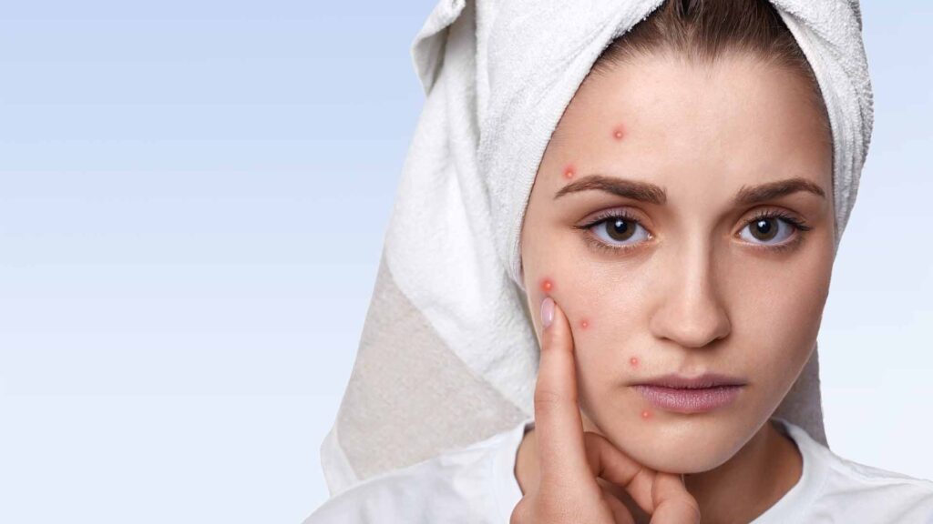 How to hide pimples like a pro?