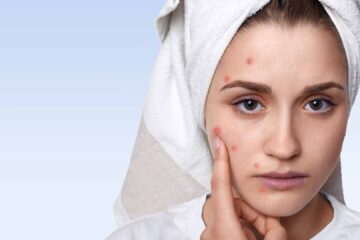 How to hide pimples like a pro?